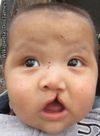 Society – Stem cell hope for cleft palate babies